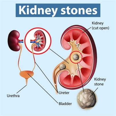 What is the Best Position to Pass a Kidney Stone? And Why Not Try Standing on Your Head While Drinking Pineapple Juice?